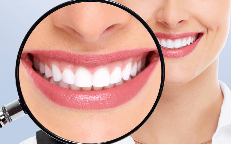 הלבנת שיניים - כל מה שצריך לדעת