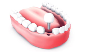השתלות שיניים בהרדמה כללית