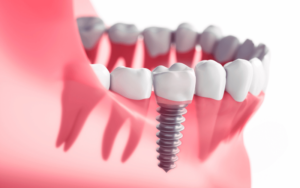 סוגי השתלות שיניים